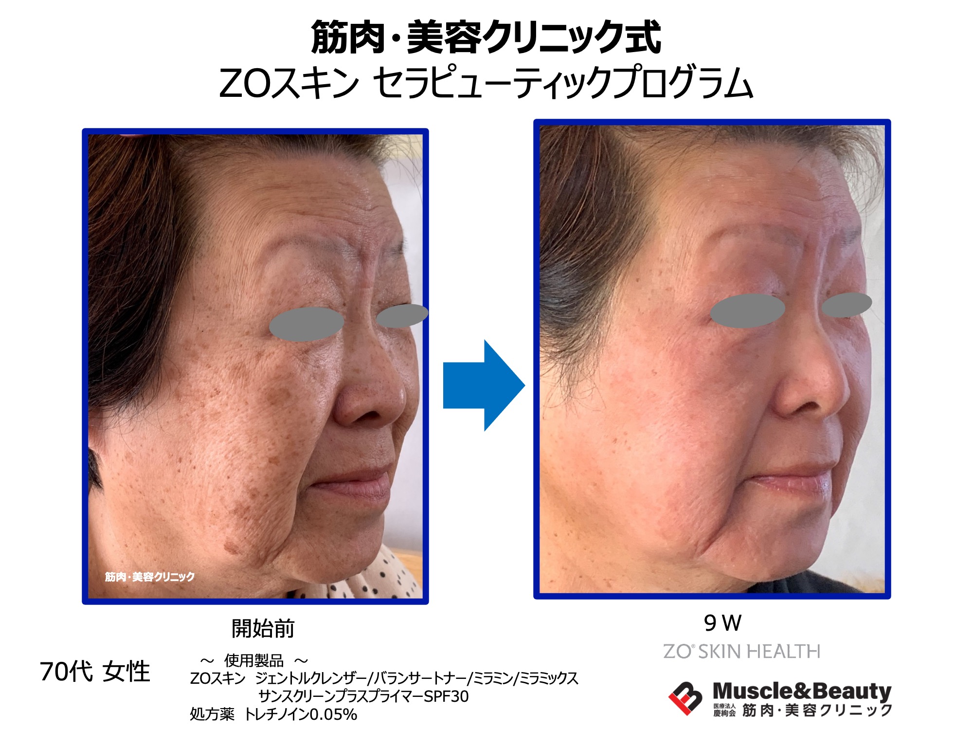 ゼオスキン ゼオスキンのセラピューティック ２ | 福岡市城南区の美容皮膚科